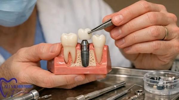 ایمپلنت دیجیتال برای چه کسانی مناسب است؟ آنالیز تخصصی مزایا و کاندیداهای ایده آل ایمپلنت دیجیتال برای چه کسانی مناسب است؟ آنالیز تخصصی مزایا و کاندیداهای ایده آل